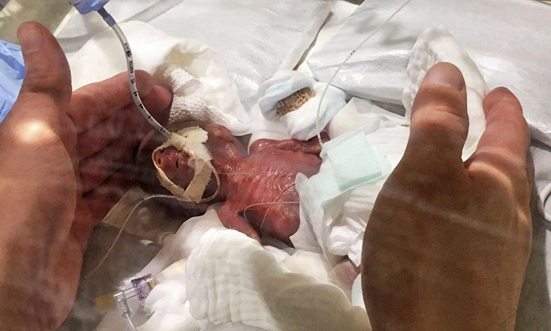World’s smallest baby boy born weighing 268 grams returns home healthy