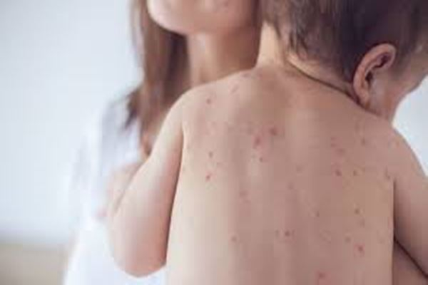 Measles outbreak in New Zealand’s Canterbury widens to 20