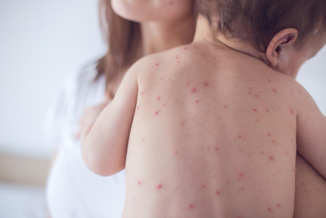 US measles outbreak climbs to 880 with 41 new cases