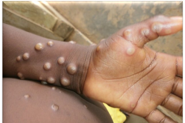 US confirms 9 monkeypox cases in 7 states