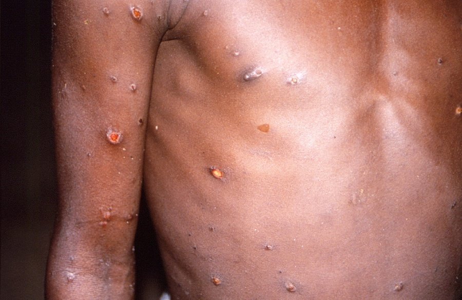 Canada confirms first two monkeypox cases