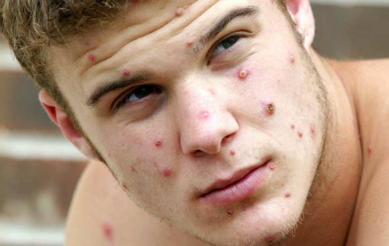 WHO expects more cases of monkeypox to emerge globally; 92 confirmed cases reported in 12 countries