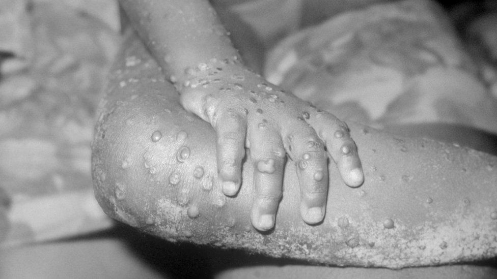 Monkeypox cases in Brazil rise to 76; Colombia rises to 5