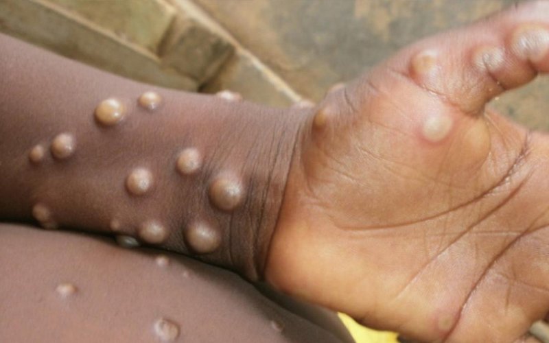 Ethiopia heightens surveillance for monkeypox
