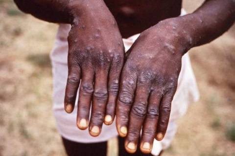 Nigeria: Katsina State records 4 cases of Monkeypox as it battles cholera, lassa fever, covid-19