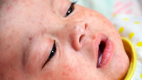 Measles cases spike in Juba and Terekeka counties in South Sudan