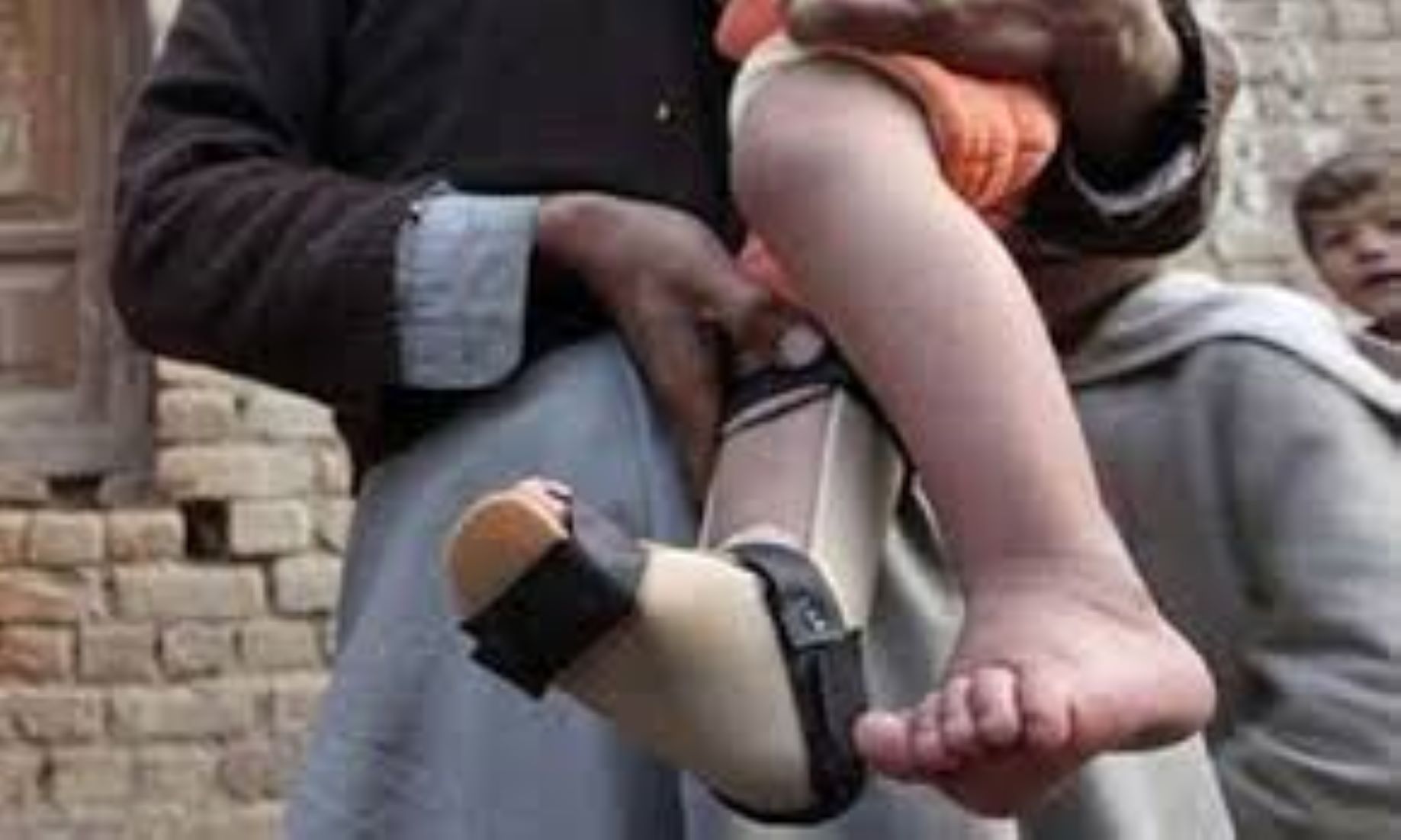 Pakistan Records Fifth Polio Case This Year