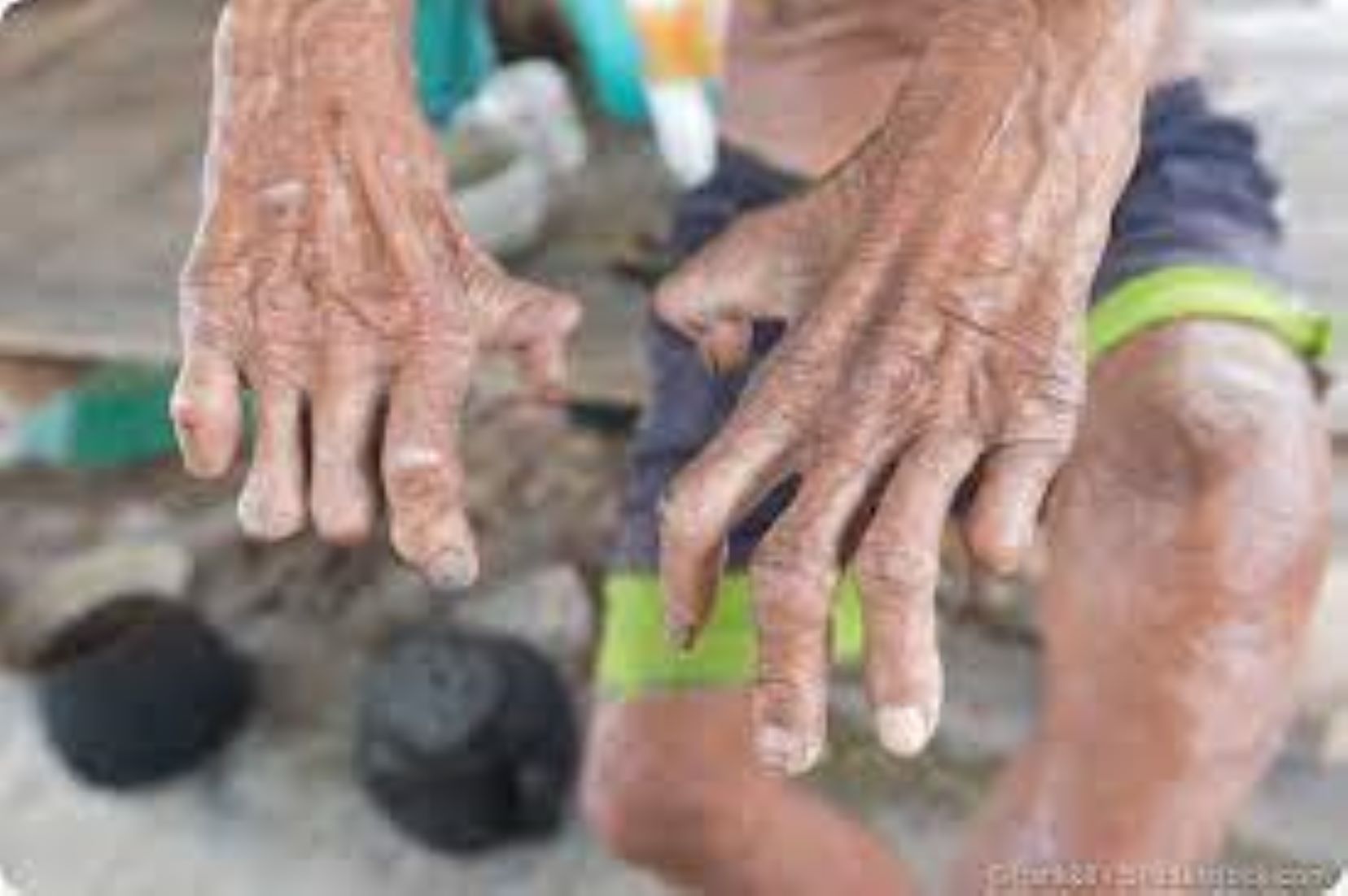 Malaysia Saw 40 Percent Rise In Leprosy Cases Last Year