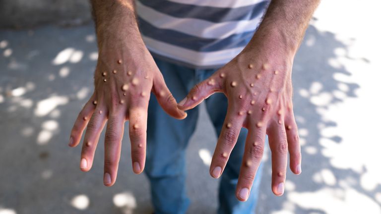 First UK case of mpox variant clade Ib detected in London