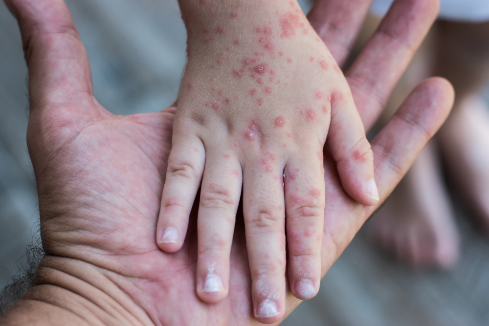 Philippines Tallies More Hand, Foot And Mouth Disease Cases