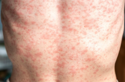 Mongolia’s Total Number Of Confirmed Measles Cases Exceeds 1,000