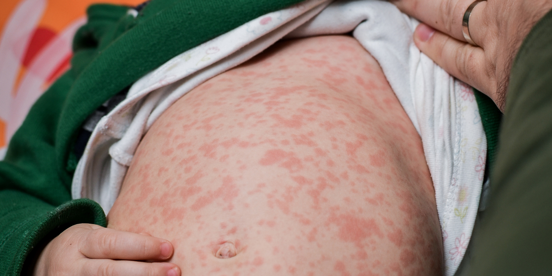 Mongolia’s Total Measles Cases Top 2,000