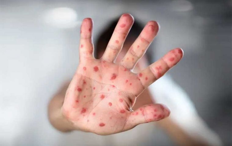 Uruguay: Chickenpox cases up 71.5%