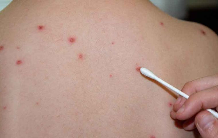 Paraguay: Emergency declared due to measles outbreak