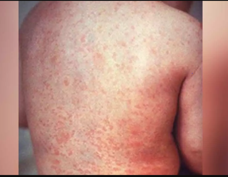 Mongolia’s Measles Cases Surpass 13,000